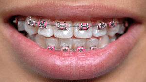 What Do Rubber Bands Do for Braces? - Gorman & Bunch Orthodontics -  Greenwood, IN