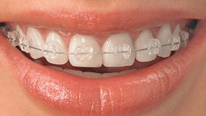 What Is the Purpose of Rubber Bands in Braces? - Thurman Orthodontics