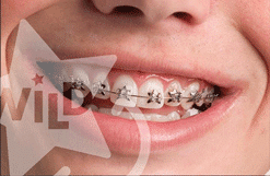 What Is the Purpose of Rubber Bands in Braces? - Thurman Orthodontics