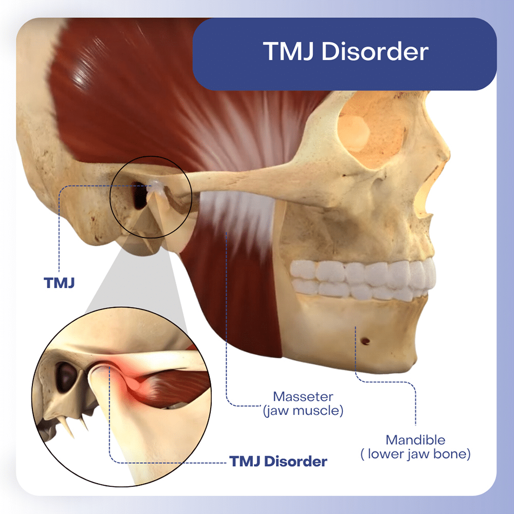 TMJ Disorder Musgrave Orthodontics in Delaware and Waldo, OH